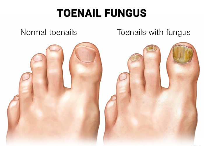 Toenail Fungus