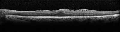 Macular Pucker