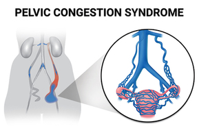 Pelvic Congestion Syndrome (PCS) Treatment