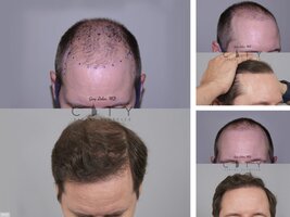 Follicular Unit Transplantation (FUT)