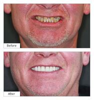 Dental Implants in Broadway Family Dental