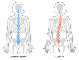 Scoliosis Surgery in Hackensack, NJ