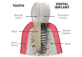 Dental Implants in 505 Dental Associates from $1000 to $4000