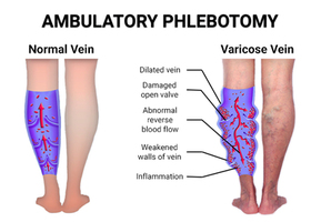 Phlebotomy Varicose Veins in Bronx