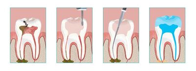 Root Canal Procedure