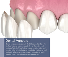 Dental Veneers in New York, NY