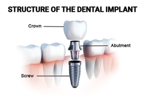 Components of Dental Implants