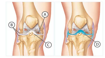 Knee Pain Treatment in NYC | Knee Pain Doctors Specialists