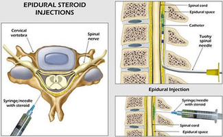 Cervical Epidural Steroid Injection