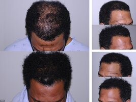 Hair Transplants for African Americans