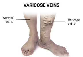 Vein Treatments in Brooklyn, NY