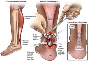 Achilles Tendon Surgery