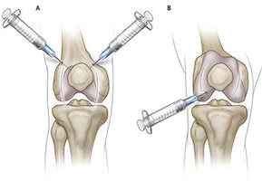 Knee Injections for Osteoarthritis in NYC