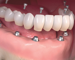 Full Mouth Dental Implants