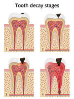 Tooth Pain After Filling, Wisdom Pain