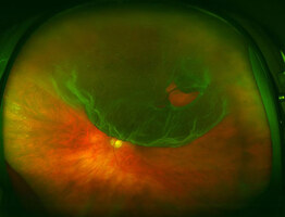 Retinal Detachment Surgery