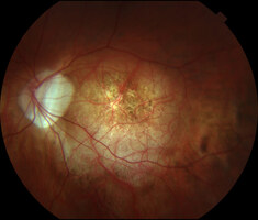 Myopic Degeneration