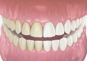 Zoom Teeth Whitening in Stamford, CT