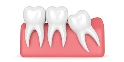 Wisdom Teeth Removal Cost Epping | Affordable & Expert Care