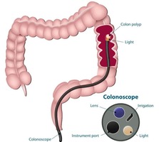 Colonoscopy in Manhattan Gastroenterology