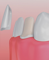 Dental Veneers