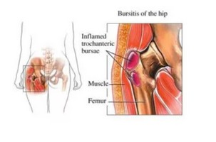 Hip Pain Treatment