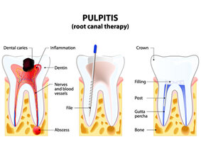 Root Canal Therapy in Astoria, Queens