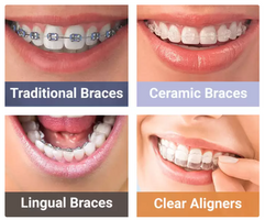 Dental Braces