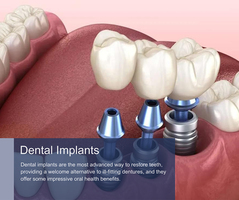 Dental Implants in New York, NY