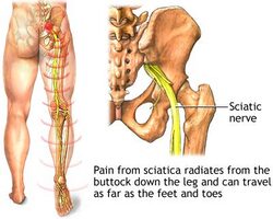 Sciatica Treatment Doctors, Top Specialists in Brooklyn NYC