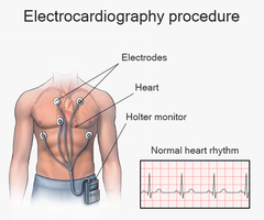 Electrocardiogram (EKG or ECG)