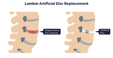 Disc Replacement Surgery in Hackensack, NJ