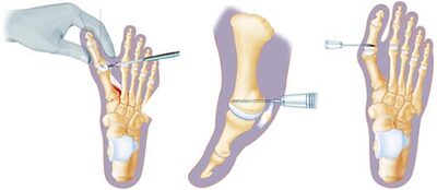 Minimally Invasive Surgery