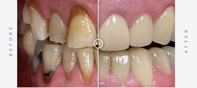 Dental Crowns in South Nassau Dental Arts