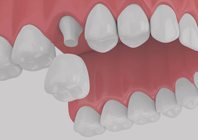 Dental Crowns in Stamford, CT