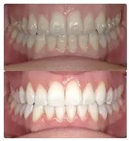 Teeth Whitening in Gibbs Orthodontic Associates, P.C: Invisalign, Braces and Dentofacial Orthopedics