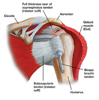 NYC Shoulder Injuries Treatment Doctor Specialist