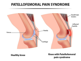 Patellofemoral Pain Syndrome