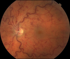 Retinal Vein Occlusion