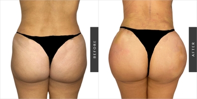 Butt Implants Buttock Augmentation Surgeon