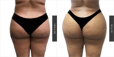 Butt Lift Buttock Plastic Surgery