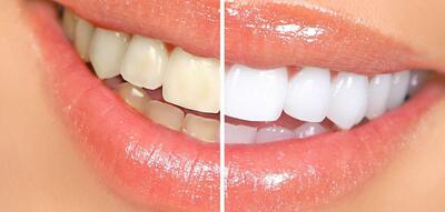 Teeth Whitening at the Dentist Price: A Comprehensive Guide