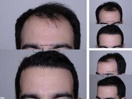 What Constitutes a Hair Loss Treatment?