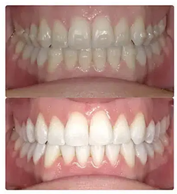 Teeth Whitening in Gibbs Orthodontic Associates, P.C: Invisalign, Braces and Dentofacial Orthopedics