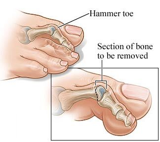 Hammer Toe Surgery