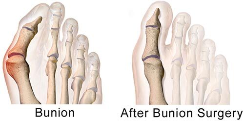Bunion Surgery