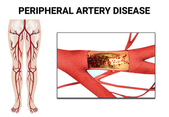 Peripheral Artery Disease Treatment