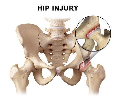 Hip Pain Treatment in NYC