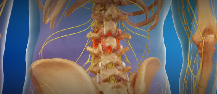 Spinal Fusion Surgery in Hackensack, NJ