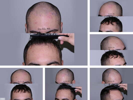 How Much Will a Hair Transplant Cost Me?